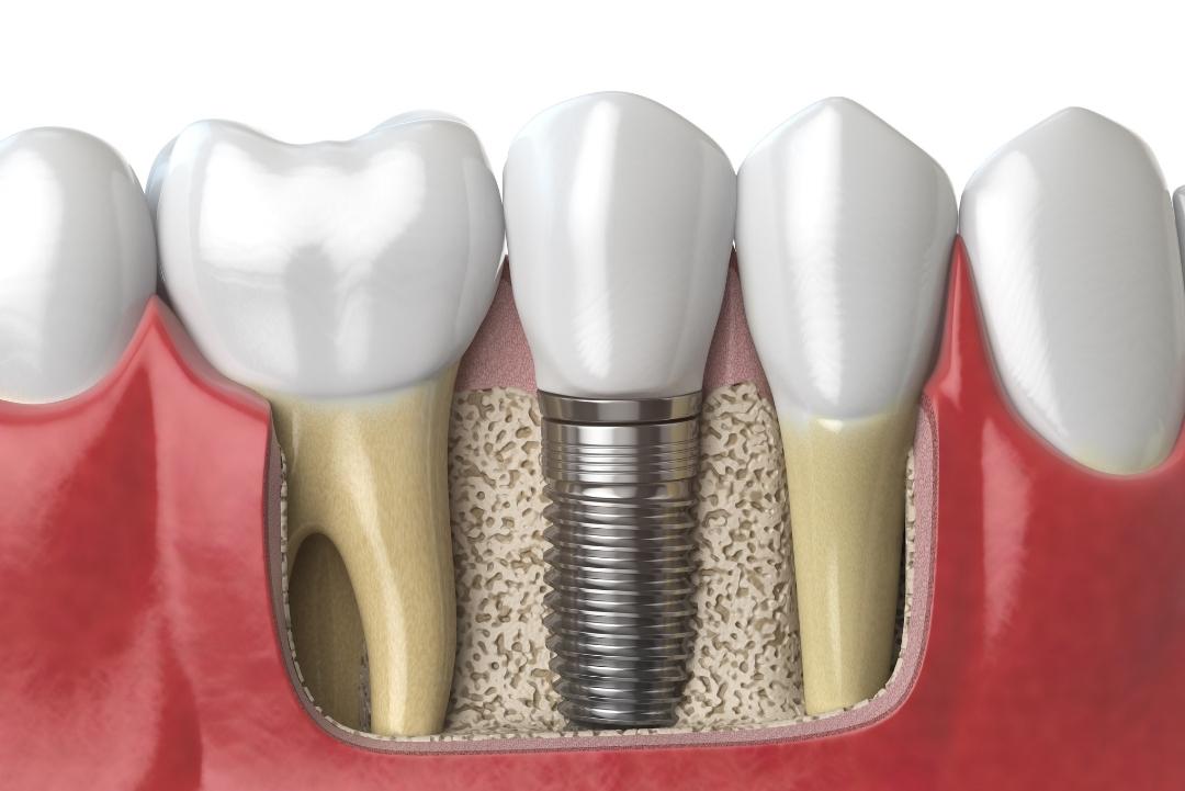 Dental Implants in Brampton