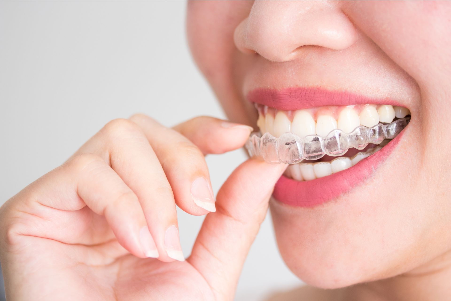 Invisalign Dentist Brampton - Dentist In Brampton 2022